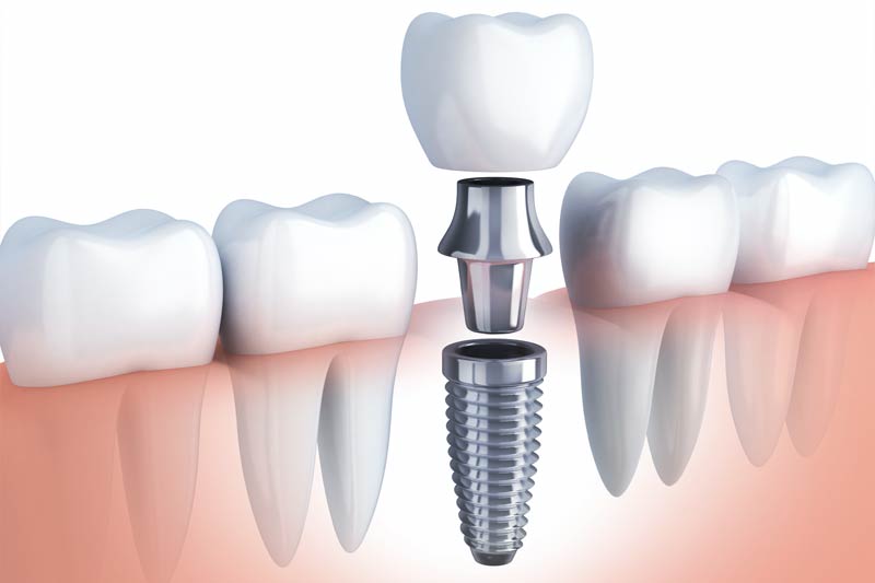 Implants Dentist in Roswell